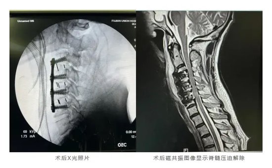 脊髓損傷最新突破，科技重塑生活，璀璨突破展現科技力量